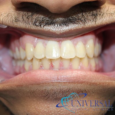 Universal dental, Dentista cerca de mi; Dentista hispano cerca de mi; Clinica dental cerca de mi ubicacion; Dentista que hable espanol cerca de mi; Mejor dentista en mi ciudad; Dentista de emergencia; Urgencias dentales 24 horas; Sacar cita con dentista hoy; Limpieza dental precio; Implantes dentales economicos; Ortodoncia para adultos; Blanqueamiento dental; Dentista para niños; Dentista pediatrico; Dentista barato y bueno; Clinica dental economica; Dentista que acepte mi seguro; Dentista sin seguro medico; Tratamiento de conducto; Extraccion de muela de juicio; Ortodoncia cerca de mi; Clinica de ortodoncia cerca de mi; Mejor clinica de ortodoncia; Expertos en ortodoncia cerca de mi; Ortodoncia para adultos; Ortodoncia para niños; Ortodoncia precios y planes; Ortodoncia economico; Tratamiento de ortodoncia hoy; Dentist near me; Hispanic dentist near me; Dental clinic near my location; Spanish speaking dentist near me; Best dentist in my city; Emergency dentist; 24 hour dental emergencies; Book dentist appointment today; Dental cleaning cost; Affordable dental implants; Orthodontics for adults; Teeth whitening; Dentist for kids; Pediatric dentist; Cheap and good dentist; Affordable dental clinic; Dentist that accepts my insurance; Dentist without medical insurance; Root canal treatment; Wisdom tooth extraction; Orthodontics near me; Orthodontics clinic near me; Best orthodontics clinic; Orthodontics experts near me; Orthodontics for adults; Orthodontics for kids; Orthodontics prices and plans; Affordable orthodontics; Orthodontics treatment today