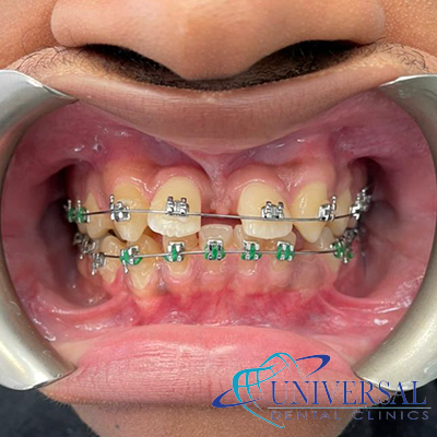 Universal dental, Dentista cerca de mi; Dentista hispano cerca de mi; Clinica dental cerca de mi ubicacion; Dentista que hable espanol cerca de mi; Mejor dentista en mi ciudad; Dentista de emergencia; Urgencias dentales 24 horas; Sacar cita con dentista hoy; Limpieza dental precio; Implantes dentales economicos; Ortodoncia para adultos; Blanqueamiento dental; Dentista para niños; Dentista pediatrico; Dentista barato y bueno; Clinica dental economica; Dentista que acepte mi seguro; Dentista sin seguro medico; Tratamiento de conducto; Extraccion de muela de juicio; Ortodoncia cerca de mi; Clinica de ortodoncia cerca de mi; Mejor clinica de ortodoncia; Expertos en ortodoncia cerca de mi; Ortodoncia para adultos; Ortodoncia para niños; Ortodoncia precios y planes; Ortodoncia economico; Tratamiento de ortodoncia hoy; Dentist near me; Hispanic dentist near me; Dental clinic near my location; Spanish speaking dentist near me; Best dentist in my city; Emergency dentist; 24 hour dental emergencies; Book dentist appointment today; Dental cleaning cost; Affordable dental implants; Orthodontics for adults; Teeth whitening; Dentist for kids; Pediatric dentist; Cheap and good dentist; Affordable dental clinic; Dentist that accepts my insurance; Dentist without medical insurance; Root canal treatment; Wisdom tooth extraction; Orthodontics near me; Orthodontics clinic near me; Best orthodontics clinic; Orthodontics experts near me; Orthodontics for adults; Orthodontics for kids; Orthodontics prices and plans; Affordable orthodontics; Orthodontics treatment today