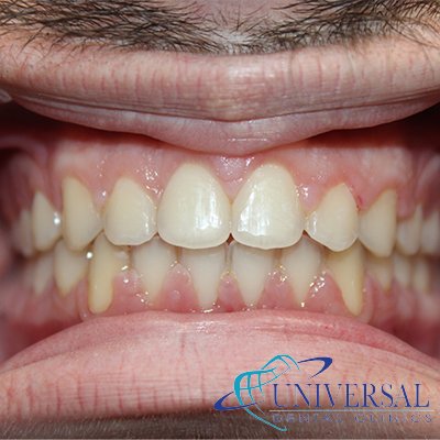 Universal dental, Dentista cerca de mi; Dentista hispano cerca de mi; Clinica dental cerca de mi ubicacion; Dentista que hable espanol cerca de mi; Mejor dentista en mi ciudad; Dentista de emergencia; Urgencias dentales 24 horas; Sacar cita con dentista hoy; Limpieza dental precio; Implantes dentales economicos; Ortodoncia para adultos; Blanqueamiento dental; Dentista para niños; Dentista pediatrico; Dentista barato y bueno; Clinica dental economica; Dentista que acepte mi seguro; Dentista sin seguro medico; Tratamiento de conducto; Extraccion de muela de juicio; Ortodoncia cerca de mi; Clinica de ortodoncia cerca de mi; Mejor clinica de ortodoncia; Expertos en ortodoncia cerca de mi; Ortodoncia para adultos; Ortodoncia para niños; Ortodoncia precios y planes; Ortodoncia economico; Tratamiento de ortodoncia hoy; Dentist near me; Hispanic dentist near me; Dental clinic near my location; Spanish speaking dentist near me; Best dentist in my city; Emergency dentist; 24 hour dental emergencies; Book dentist appointment today; Dental cleaning cost; Affordable dental implants; Orthodontics for adults; Teeth whitening; Dentist for kids; Pediatric dentist; Cheap and good dentist; Affordable dental clinic; Dentist that accepts my insurance; Dentist without medical insurance; Root canal treatment; Wisdom tooth extraction; Orthodontics near me; Orthodontics clinic near me; Best orthodontics clinic; Orthodontics experts near me; Orthodontics for adults; Orthodontics for kids; Orthodontics prices and plans; Affordable orthodontics; Orthodontics treatment today