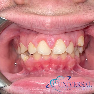 Universal dental, Dentista cerca de mi; Dentista hispano cerca de mi; Clinica dental cerca de mi ubicacion; Dentista que hable espanol cerca de mi; Mejor dentista en mi ciudad; Dentista de emergencia; Urgencias dentales 24 horas; Sacar cita con dentista hoy; Limpieza dental precio; Implantes dentales economicos; Ortodoncia para adultos; Blanqueamiento dental; Dentista para niños; Dentista pediatrico; Dentista barato y bueno; Clinica dental economica; Dentista que acepte mi seguro; Dentista sin seguro medico; Tratamiento de conducto; Extraccion de muela de juicio; Ortodoncia cerca de mi; Clinica de ortodoncia cerca de mi; Mejor clinica de ortodoncia; Expertos en ortodoncia cerca de mi; Ortodoncia para adultos; Ortodoncia para niños; Ortodoncia precios y planes; Ortodoncia economico; Tratamiento de ortodoncia hoy; Dentist near me; Hispanic dentist near me; Dental clinic near my location; Spanish speaking dentist near me; Best dentist in my city; Emergency dentist; 24 hour dental emergencies; Book dentist appointment today; Dental cleaning cost; Affordable dental implants; Orthodontics for adults; Teeth whitening; Dentist for kids; Pediatric dentist; Cheap and good dentist; Affordable dental clinic; Dentist that accepts my insurance; Dentist without medical insurance; Root canal treatment; Wisdom tooth extraction; Orthodontics near me; Orthodontics clinic near me; Best orthodontics clinic; Orthodontics experts near me; Orthodontics for adults; Orthodontics for kids; Orthodontics prices and plans; Affordable orthodontics; Orthodontics treatment today