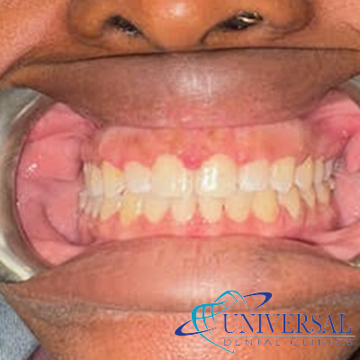 Universal dental, Dentista cerca de mi; Dentista hispano cerca de mi; Clinica dental cerca de mi ubicacion; Dentista que hable espanol cerca de mi; Mejor dentista en mi ciudad; Dentista de emergencia; Urgencias dentales 24 horas; Sacar cita con dentista hoy; Limpieza dental precio; Implantes dentales economicos; Ortodoncia para adultos; Blanqueamiento dental; Dentista para niños; Dentista pediatrico; Dentista barato y bueno; Clinica dental economica; Dentista que acepte mi seguro; Dentista sin seguro medico; Tratamiento de conducto; Extraccion de muela de juicio; Ortodoncia cerca de mi; Clinica de ortodoncia cerca de mi; Mejor clinica de ortodoncia; Expertos en ortodoncia cerca de mi; Ortodoncia para adultos; Ortodoncia para niños; Ortodoncia precios y planes; Ortodoncia economico; Tratamiento de ortodoncia hoy; Dentist near me; Hispanic dentist near me; Dental clinic near my location; Spanish speaking dentist near me; Best dentist in my city; Emergency dentist; 24 hour dental emergencies; Book dentist appointment today; Dental cleaning cost; Affordable dental implants; Orthodontics for adults; Teeth whitening; Dentist for kids; Pediatric dentist; Cheap and good dentist; Affordable dental clinic; Dentist that accepts my insurance; Dentist without medical insurance; Root canal treatment; Wisdom tooth extraction; Orthodontics near me; Orthodontics clinic near me; Best orthodontics clinic; Orthodontics experts near me; Orthodontics for adults; Orthodontics for kids; Orthodontics prices and plans; Affordable orthodontics; Orthodontics treatment today