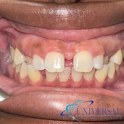 Universal dental, Dentista cerca de mi; Dentista hispano cerca de mi; Clinica dental cerca de mi ubicacion; Dentista que hable espanol cerca de mi; Mejor dentista en mi ciudad; Dentista de emergencia; Urgencias dentales 24 horas; Sacar cita con dentista hoy; Limpieza dental precio; Implantes dentales economicos; Ortodoncia para adultos; Blanqueamiento dental; Dentista para niños; Dentista pediatrico; Dentista barato y bueno; Clinica dental economica; Dentista que acepte mi seguro; Dentista sin seguro medico; Tratamiento de conducto; Extraccion de muela de juicio; Ortodoncia cerca de mi; Clinica de ortodoncia cerca de mi; Mejor clinica de ortodoncia; Expertos en ortodoncia cerca de mi; Ortodoncia para adultos; Ortodoncia para niños; Ortodoncia precios y planes; Ortodoncia economico; Tratamiento de ortodoncia hoy; Dentist near me; Hispanic dentist near me; Dental clinic near my location; Spanish speaking dentist near me; Best dentist in my city; Emergency dentist; 24 hour dental emergencies; Book dentist appointment today; Dental cleaning cost; Affordable dental implants; Orthodontics for adults; Teeth whitening; Dentist for kids; Pediatric dentist; Cheap and good dentist; Affordable dental clinic; Dentist that accepts my insurance; Dentist without medical insurance; Root canal treatment; Wisdom tooth extraction; Orthodontics near me; Orthodontics clinic near me; Best orthodontics clinic; Orthodontics experts near me; Orthodontics for adults; Orthodontics for kids; Orthodontics prices and plans; Affordable orthodontics; Orthodontics treatment today
