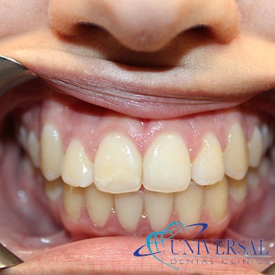 Universal dental, Dentista cerca de mi; Dentista hispano cerca de mi; Clinica dental cerca de mi ubicacion; Dentista que hable espanol cerca de mi; Mejor dentista en mi ciudad; Dentista de emergencia; Urgencias dentales 24 horas; Sacar cita con dentista hoy; Limpieza dental precio; Implantes dentales economicos; Ortodoncia para adultos; Blanqueamiento dental; Dentista para niños; Dentista pediatrico; Dentista barato y bueno; Clinica dental economica; Dentista que acepte mi seguro; Dentista sin seguro medico; Tratamiento de conducto; Extraccion de muela de juicio; Ortodoncia cerca de mi; Clinica de ortodoncia cerca de mi; Mejor clinica de ortodoncia; Expertos en ortodoncia cerca de mi; Ortodoncia para adultos; Ortodoncia para niños; Ortodoncia precios y planes; Ortodoncia economico; Tratamiento de ortodoncia hoy; Dentist near me; Hispanic dentist near me; Dental clinic near my location; Spanish speaking dentist near me; Best dentist in my city; Emergency dentist; 24 hour dental emergencies; Book dentist appointment today; Dental cleaning cost; Affordable dental implants; Orthodontics for adults; Teeth whitening; Dentist for kids; Pediatric dentist; Cheap and good dentist; Affordable dental clinic; Dentist that accepts my insurance; Dentist without medical insurance; Root canal treatment; Wisdom tooth extraction; Orthodontics near me; Orthodontics clinic near me; Best orthodontics clinic; Orthodontics experts near me; Orthodontics for adults; Orthodontics for kids; Orthodontics prices and plans; Affordable orthodontics; Orthodontics treatment today
