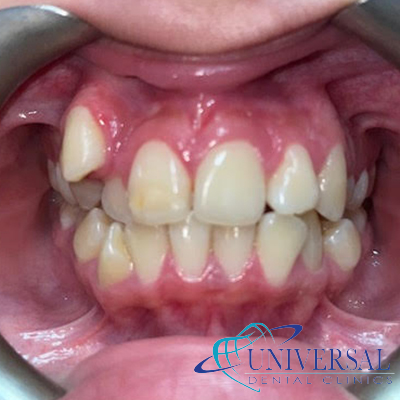 Universal dental, Dentista cerca de mi; Dentista hispano cerca de mi; Clinica dental cerca de mi ubicacion; Dentista que hable espanol cerca de mi; Mejor dentista en mi ciudad; Dentista de emergencia; Urgencias dentales 24 horas; Sacar cita con dentista hoy; Limpieza dental precio; Implantes dentales economicos; Ortodoncia para adultos; Blanqueamiento dental; Dentista para niños; Dentista pediatrico; Dentista barato y bueno; Clinica dental economica; Dentista que acepte mi seguro; Dentista sin seguro medico; Tratamiento de conducto; Extraccion de muela de juicio; Ortodoncia cerca de mi; Clinica de ortodoncia cerca de mi; Mejor clinica de ortodoncia; Expertos en ortodoncia cerca de mi; Ortodoncia para adultos; Ortodoncia para niños; Ortodoncia precios y planes; Ortodoncia economico; Tratamiento de ortodoncia hoy; Dentist near me; Hispanic dentist near me; Dental clinic near my location; Spanish speaking dentist near me; Best dentist in my city; Emergency dentist; 24 hour dental emergencies; Book dentist appointment today; Dental cleaning cost; Affordable dental implants; Orthodontics for adults; Teeth whitening; Dentist for kids; Pediatric dentist; Cheap and good dentist; Affordable dental clinic; Dentist that accepts my insurance; Dentist without medical insurance; Root canal treatment; Wisdom tooth extraction; Orthodontics near me; Orthodontics clinic near me; Best orthodontics clinic; Orthodontics experts near me; Orthodontics for adults; Orthodontics for kids; Orthodontics prices and plans; Affordable orthodontics; Orthodontics treatment today