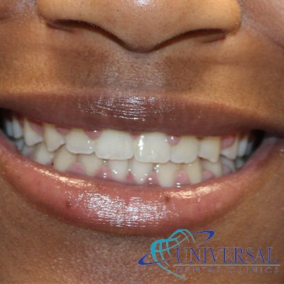 Universal dental, Dentista cerca de mi; Dentista hispano cerca de mi; Clinica dental cerca de mi ubicacion; Dentista que hable espanol cerca de mi; Mejor dentista en mi ciudad; Dentista de emergencia; Urgencias dentales 24 horas; Sacar cita con dentista hoy; Limpieza dental precio; Implantes dentales economicos; Ortodoncia para adultos; Blanqueamiento dental; Dentista para niños; Dentista pediatrico; Dentista barato y bueno; Clinica dental economica; Dentista que acepte mi seguro; Dentista sin seguro medico; Tratamiento de conducto; Extraccion de muela de juicio; Ortodoncia cerca de mi; Clinica de ortodoncia cerca de mi; Mejor clinica de ortodoncia; Expertos en ortodoncia cerca de mi; Ortodoncia para adultos; Ortodoncia para niños; Ortodoncia precios y planes; Ortodoncia economico; Tratamiento de ortodoncia hoy; Dentist near me; Hispanic dentist near me; Dental clinic near my location; Spanish speaking dentist near me; Best dentist in my city; Emergency dentist; 24 hour dental emergencies; Book dentist appointment today; Dental cleaning cost; Affordable dental implants; Orthodontics for adults; Teeth whitening; Dentist for kids; Pediatric dentist; Cheap and good dentist; Affordable dental clinic; Dentist that accepts my insurance; Dentist without medical insurance; Root canal treatment; Wisdom tooth extraction; Orthodontics near me; Orthodontics clinic near me; Best orthodontics clinic; Orthodontics experts near me; Orthodontics for adults; Orthodontics for kids; Orthodontics prices and plans; Affordable orthodontics; Orthodontics treatment today