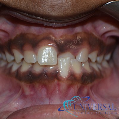 Universal dental, Dentista cerca de mi; Dentista hispano cerca de mi; Clinica dental cerca de mi ubicacion; Dentista que hable espanol cerca de mi; Mejor dentista en mi ciudad; Dentista de emergencia; Urgencias dentales 24 horas; Sacar cita con dentista hoy; Limpieza dental precio; Implantes dentales economicos; Ortodoncia para adultos; Blanqueamiento dental; Dentista para niños; Dentista pediatrico; Dentista barato y bueno; Clinica dental economica; Dentista que acepte mi seguro; Dentista sin seguro medico; Tratamiento de conducto; Extraccion de muela de juicio; Ortodoncia cerca de mi; Clinica de ortodoncia cerca de mi; Mejor clinica de ortodoncia; Expertos en ortodoncia cerca de mi; Ortodoncia para adultos; Ortodoncia para niños; Ortodoncia precios y planes; Ortodoncia economico; Tratamiento de ortodoncia hoy; Dentist near me; Hispanic dentist near me; Dental clinic near my location; Spanish speaking dentist near me; Best dentist in my city; Emergency dentist; 24 hour dental emergencies; Book dentist appointment today; Dental cleaning cost; Affordable dental implants; Orthodontics for adults; Teeth whitening; Dentist for kids; Pediatric dentist; Cheap and good dentist; Affordable dental clinic; Dentist that accepts my insurance; Dentist without medical insurance; Root canal treatment; Wisdom tooth extraction; Orthodontics near me; Orthodontics clinic near me; Best orthodontics clinic; Orthodontics experts near me; Orthodontics for adults; Orthodontics for kids; Orthodontics prices and plans; Affordable orthodontics; Orthodontics treatment today