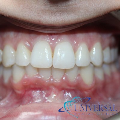 Universal dental, Dentista cerca de mi; Dentista hispano cerca de mi; Clinica dental cerca de mi ubicacion; Dentista que hable espanol cerca de mi; Mejor dentista en mi ciudad; Dentista de emergencia; Urgencias dentales 24 horas; Sacar cita con dentista hoy; Limpieza dental precio; Implantes dentales economicos; Ortodoncia para adultos; Blanqueamiento dental; Dentista para niños; Dentista pediatrico; Dentista barato y bueno; Clinica dental economica; Dentista que acepte mi seguro; Dentista sin seguro medico; Tratamiento de conducto; Extraccion de muela de juicio; Ortodoncia cerca de mi; Clinica de ortodoncia cerca de mi; Mejor clinica de ortodoncia; Expertos en ortodoncia cerca de mi; Ortodoncia para adultos; Ortodoncia para niños; Ortodoncia precios y planes; Ortodoncia economico; Tratamiento de ortodoncia hoy; Dentist near me; Hispanic dentist near me; Dental clinic near my location; Spanish speaking dentist near me; Best dentist in my city; Emergency dentist; 24 hour dental emergencies; Book dentist appointment today; Dental cleaning cost; Affordable dental implants; Orthodontics for adults; Teeth whitening; Dentist for kids; Pediatric dentist; Cheap and good dentist; Affordable dental clinic; Dentist that accepts my insurance; Dentist without medical insurance; Root canal treatment; Wisdom tooth extraction; Orthodontics near me; Orthodontics clinic near me; Best orthodontics clinic; Orthodontics experts near me; Orthodontics for adults; Orthodontics for kids; Orthodontics prices and plans; Affordable orthodontics; Orthodontics treatment today
