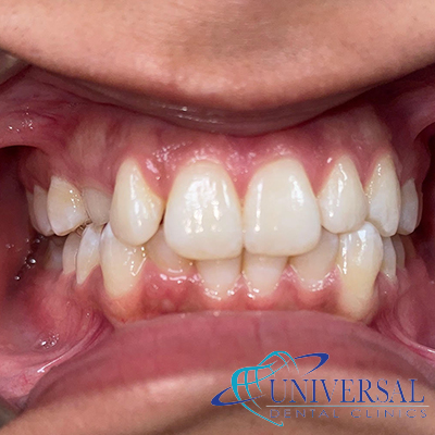 Universal dental, Dentista cerca de mi; Dentista hispano cerca de mi; Clinica dental cerca de mi ubicacion; Dentista que hable espanol cerca de mi; Mejor dentista en mi ciudad; Dentista de emergencia; Urgencias dentales 24 horas; Sacar cita con dentista hoy; Limpieza dental precio; Implantes dentales economicos; Ortodoncia para adultos; Blanqueamiento dental; Dentista para niños; Dentista pediatrico; Dentista barato y bueno; Clinica dental economica; Dentista que acepte mi seguro; Dentista sin seguro medico; Tratamiento de conducto; Extraccion de muela de juicio; Ortodoncia cerca de mi; Clinica de ortodoncia cerca de mi; Mejor clinica de ortodoncia; Expertos en ortodoncia cerca de mi; Ortodoncia para adultos; Ortodoncia para niños; Ortodoncia precios y planes; Ortodoncia economico; Tratamiento de ortodoncia hoy; Dentist near me; Hispanic dentist near me; Dental clinic near my location; Spanish speaking dentist near me; Best dentist in my city; Emergency dentist; 24 hour dental emergencies; Book dentist appointment today; Dental cleaning cost; Affordable dental implants; Orthodontics for adults; Teeth whitening; Dentist for kids; Pediatric dentist; Cheap and good dentist; Affordable dental clinic; Dentist that accepts my insurance; Dentist without medical insurance; Root canal treatment; Wisdom tooth extraction; Orthodontics near me; Orthodontics clinic near me; Best orthodontics clinic; Orthodontics experts near me; Orthodontics for adults; Orthodontics for kids; Orthodontics prices and plans; Affordable orthodontics; Orthodontics treatment today