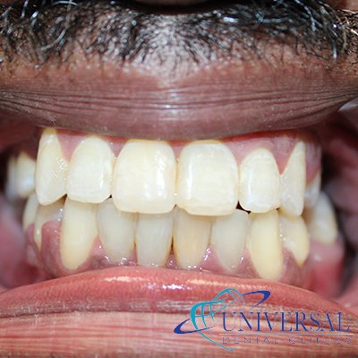 Universal dental, Dentista cerca de mi; Dentista hispano cerca de mi; Clinica dental cerca de mi ubicacion; Dentista que hable espanol cerca de mi; Mejor dentista en mi ciudad; Dentista de emergencia; Urgencias dentales 24 horas; Sacar cita con dentista hoy; Limpieza dental precio; Implantes dentales economicos; Ortodoncia para adultos; Blanqueamiento dental; Dentista para niños; Dentista pediatrico; Dentista barato y bueno; Clinica dental economica; Dentista que acepte mi seguro; Dentista sin seguro medico; Tratamiento de conducto; Extraccion de muela de juicio; Ortodoncia cerca de mi; Clinica de ortodoncia cerca de mi; Mejor clinica de ortodoncia; Expertos en ortodoncia cerca de mi; Ortodoncia para adultos; Ortodoncia para niños; Ortodoncia precios y planes; Ortodoncia economico; Tratamiento de ortodoncia hoy; Dentist near me; Hispanic dentist near me; Dental clinic near my location; Spanish speaking dentist near me; Best dentist in my city; Emergency dentist; 24 hour dental emergencies; Book dentist appointment today; Dental cleaning cost; Affordable dental implants; Orthodontics for adults; Teeth whitening; Dentist for kids; Pediatric dentist; Cheap and good dentist; Affordable dental clinic; Dentist that accepts my insurance; Dentist without medical insurance; Root canal treatment; Wisdom tooth extraction; Orthodontics near me; Orthodontics clinic near me; Best orthodontics clinic; Orthodontics experts near me; Orthodontics for adults; Orthodontics for kids; Orthodontics prices and plans; Affordable orthodontics; Orthodontics treatment today