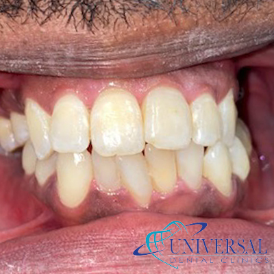Universal dental, Dentista cerca de mi; Dentista hispano cerca de mi; Clinica dental cerca de mi ubicacion; Dentista que hable espanol cerca de mi; Mejor dentista en mi ciudad; Dentista de emergencia; Urgencias dentales 24 horas; Sacar cita con dentista hoy; Limpieza dental precio; Implantes dentales economicos; Ortodoncia para adultos; Blanqueamiento dental; Dentista para niños; Dentista pediatrico; Dentista barato y bueno; Clinica dental economica; Dentista que acepte mi seguro; Dentista sin seguro medico; Tratamiento de conducto; Extraccion de muela de juicio; Ortodoncia cerca de mi; Clinica de ortodoncia cerca de mi; Mejor clinica de ortodoncia; Expertos en ortodoncia cerca de mi; Ortodoncia para adultos; Ortodoncia para niños; Ortodoncia precios y planes; Ortodoncia economico; Tratamiento de ortodoncia hoy; Dentist near me; Hispanic dentist near me; Dental clinic near my location; Spanish speaking dentist near me; Best dentist in my city; Emergency dentist; 24 hour dental emergencies; Book dentist appointment today; Dental cleaning cost; Affordable dental implants; Orthodontics for adults; Teeth whitening; Dentist for kids; Pediatric dentist; Cheap and good dentist; Affordable dental clinic; Dentist that accepts my insurance; Dentist without medical insurance; Root canal treatment; Wisdom tooth extraction; Orthodontics near me; Orthodontics clinic near me; Best orthodontics clinic; Orthodontics experts near me; Orthodontics for adults; Orthodontics for kids; Orthodontics prices and plans; Affordable orthodontics; Orthodontics treatment today