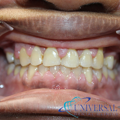 Universal dental, Dentista cerca de mi; Dentista hispano cerca de mi; Clinica dental cerca de mi ubicacion; Dentista que hable espanol cerca de mi; Mejor dentista en mi ciudad; Dentista de emergencia; Urgencias dentales 24 horas; Sacar cita con dentista hoy; Limpieza dental precio; Implantes dentales economicos; Ortodoncia para adultos; Blanqueamiento dental; Dentista para niños; Dentista pediatrico; Dentista barato y bueno; Clinica dental economica; Dentista que acepte mi seguro; Dentista sin seguro medico; Tratamiento de conducto; Extraccion de muela de juicio; Ortodoncia cerca de mi; Clinica de ortodoncia cerca de mi; Mejor clinica de ortodoncia; Expertos en ortodoncia cerca de mi; Ortodoncia para adultos; Ortodoncia para niños; Ortodoncia precios y planes; Ortodoncia economico; Tratamiento de ortodoncia hoy; Dentist near me; Hispanic dentist near me; Dental clinic near my location; Spanish speaking dentist near me; Best dentist in my city; Emergency dentist; 24 hour dental emergencies; Book dentist appointment today; Dental cleaning cost; Affordable dental implants; Orthodontics for adults; Teeth whitening; Dentist for kids; Pediatric dentist; Cheap and good dentist; Affordable dental clinic; Dentist that accepts my insurance; Dentist without medical insurance; Root canal treatment; Wisdom tooth extraction; Orthodontics near me; Orthodontics clinic near me; Best orthodontics clinic; Orthodontics experts near me; Orthodontics for adults; Orthodontics for kids; Orthodontics prices and plans; Affordable orthodontics; Orthodontics treatment today