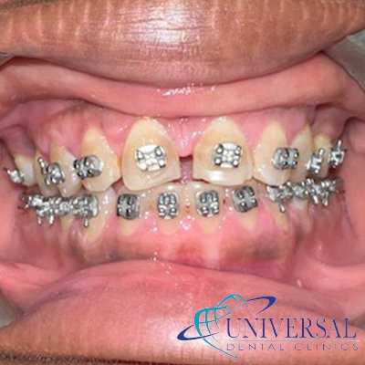 Universal dental, Dentista cerca de mi; Dentista hispano cerca de mi; Clinica dental cerca de mi ubicacion; Dentista que hable espanol cerca de mi; Mejor dentista en mi ciudad; Dentista de emergencia; Urgencias dentales 24 horas; Sacar cita con dentista hoy; Limpieza dental precio; Implantes dentales economicos; Ortodoncia para adultos; Blanqueamiento dental; Dentista para niños; Dentista pediatrico; Dentista barato y bueno; Clinica dental economica; Dentista que acepte mi seguro; Dentista sin seguro medico; Tratamiento de conducto; Extraccion de muela de juicio; Ortodoncia cerca de mi; Clinica de ortodoncia cerca de mi; Mejor clinica de ortodoncia; Expertos en ortodoncia cerca de mi; Ortodoncia para adultos; Ortodoncia para niños; Ortodoncia precios y planes; Ortodoncia economico; Tratamiento de ortodoncia hoy; Dentist near me; Hispanic dentist near me; Dental clinic near my location; Spanish speaking dentist near me; Best dentist in my city; Emergency dentist; 24 hour dental emergencies; Book dentist appointment today; Dental cleaning cost; Affordable dental implants; Orthodontics for adults; Teeth whitening; Dentist for kids; Pediatric dentist; Cheap and good dentist; Affordable dental clinic; Dentist that accepts my insurance; Dentist without medical insurance; Root canal treatment; Wisdom tooth extraction; Orthodontics near me; Orthodontics clinic near me; Best orthodontics clinic; Orthodontics experts near me; Orthodontics for adults; Orthodontics for kids; Orthodontics prices and plans; Affordable orthodontics; Orthodontics treatment today