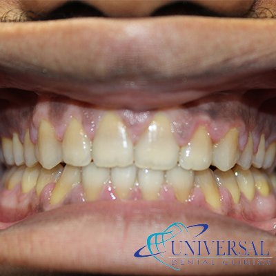 Universal dental, Dentista cerca de mi; Dentista hispano cerca de mi; Clinica dental cerca de mi ubicacion; Dentista que hable espanol cerca de mi; Mejor dentista en mi ciudad; Dentista de emergencia; Urgencias dentales 24 horas; Sacar cita con dentista hoy; Limpieza dental precio; Implantes dentales economicos; Ortodoncia para adultos; Blanqueamiento dental; Dentista para niños; Dentista pediatrico; Dentista barato y bueno; Clinica dental economica; Dentista que acepte mi seguro; Dentista sin seguro medico; Tratamiento de conducto; Extraccion de muela de juicio; Ortodoncia cerca de mi; Clinica de ortodoncia cerca de mi; Mejor clinica de ortodoncia; Expertos en ortodoncia cerca de mi; Ortodoncia para adultos; Ortodoncia para niños; Ortodoncia precios y planes; Ortodoncia economico; Tratamiento de ortodoncia hoy; Dentist near me; Hispanic dentist near me; Dental clinic near my location; Spanish speaking dentist near me; Best dentist in my city; Emergency dentist; 24 hour dental emergencies; Book dentist appointment today; Dental cleaning cost; Affordable dental implants; Orthodontics for adults; Teeth whitening; Dentist for kids; Pediatric dentist; Cheap and good dentist; Affordable dental clinic; Dentist that accepts my insurance; Dentist without medical insurance; Root canal treatment; Wisdom tooth extraction; Orthodontics near me; Orthodontics clinic near me; Best orthodontics clinic; Orthodontics experts near me; Orthodontics for adults; Orthodontics for kids; Orthodontics prices and plans; Affordable orthodontics; Orthodontics treatment today