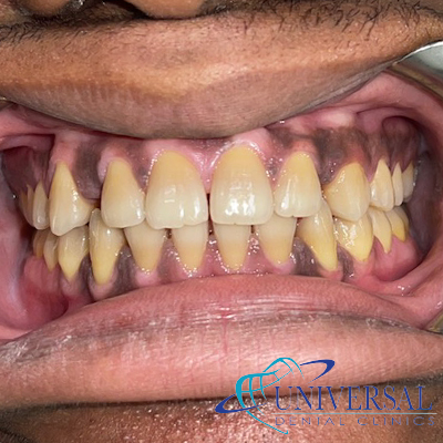 Universal dental, Dentista cerca de mi; Dentista hispano cerca de mi; Clinica dental cerca de mi ubicacion; Dentista que hable espanol cerca de mi; Mejor dentista en mi ciudad; Dentista de emergencia; Urgencias dentales 24 horas; Sacar cita con dentista hoy; Limpieza dental precio; Implantes dentales economicos; Ortodoncia para adultos; Blanqueamiento dental; Dentista para niños; Dentista pediatrico; Dentista barato y bueno; Clinica dental economica; Dentista que acepte mi seguro; Dentista sin seguro medico; Tratamiento de conducto; Extraccion de muela de juicio; Ortodoncia cerca de mi; Clinica de ortodoncia cerca de mi; Mejor clinica de ortodoncia; Expertos en ortodoncia cerca de mi; Ortodoncia para adultos; Ortodoncia para niños; Ortodoncia precios y planes; Ortodoncia economico; Tratamiento de ortodoncia hoy; Dentist near me; Hispanic dentist near me; Dental clinic near my location; Spanish speaking dentist near me; Best dentist in my city; Emergency dentist; 24 hour dental emergencies; Book dentist appointment today; Dental cleaning cost; Affordable dental implants; Orthodontics for adults; Teeth whitening; Dentist for kids; Pediatric dentist; Cheap and good dentist; Affordable dental clinic; Dentist that accepts my insurance; Dentist without medical insurance; Root canal treatment; Wisdom tooth extraction; Orthodontics near me; Orthodontics clinic near me; Best orthodontics clinic; Orthodontics experts near me; Orthodontics for adults; Orthodontics for kids; Orthodontics prices and plans; Affordable orthodontics; Orthodontics treatment today