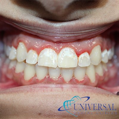 Universal dental, Dentista cerca de mi; Dentista hispano cerca de mi; Clinica dental cerca de mi ubicacion; Dentista que hable espanol cerca de mi; Mejor dentista en mi ciudad; Dentista de emergencia; Urgencias dentales 24 horas; Sacar cita con dentista hoy; Limpieza dental precio; Implantes dentales economicos; Ortodoncia para adultos; Blanqueamiento dental; Dentista para niños; Dentista pediatrico; Dentista barato y bueno; Clinica dental economica; Dentista que acepte mi seguro; Dentista sin seguro medico; Tratamiento de conducto; Extraccion de muela de juicio; Ortodoncia cerca de mi; Clinica de ortodoncia cerca de mi; Mejor clinica de ortodoncia; Expertos en ortodoncia cerca de mi; Ortodoncia para adultos; Ortodoncia para niños; Ortodoncia precios y planes; Ortodoncia economico; Tratamiento de ortodoncia hoy; Dentist near me; Hispanic dentist near me; Dental clinic near my location; Spanish speaking dentist near me; Best dentist in my city; Emergency dentist; 24 hour dental emergencies; Book dentist appointment today; Dental cleaning cost; Affordable dental implants; Orthodontics for adults; Teeth whitening; Dentist for kids; Pediatric dentist; Cheap and good dentist; Affordable dental clinic; Dentist that accepts my insurance; Dentist without medical insurance; Root canal treatment; Wisdom tooth extraction; Orthodontics near me; Orthodontics clinic near me; Best orthodontics clinic; Orthodontics experts near me; Orthodontics for adults; Orthodontics for kids; Orthodontics prices and plans; Affordable orthodontics; Orthodontics treatment today
