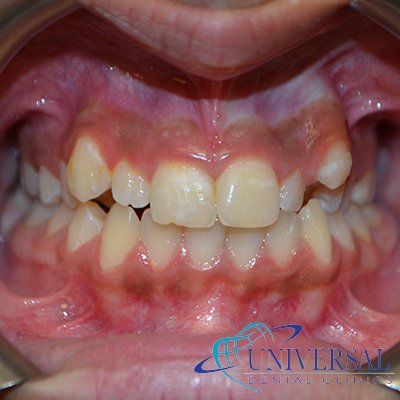 Universal dental, Dentista cerca de mi; Dentista hispano cerca de mi; Clinica dental cerca de mi ubicacion; Dentista que hable espanol cerca de mi; Mejor dentista en mi ciudad; Dentista de emergencia; Urgencias dentales 24 horas; Sacar cita con dentista hoy; Limpieza dental precio; Implantes dentales economicos; Ortodoncia para adultos; Blanqueamiento dental; Dentista para niños; Dentista pediatrico; Dentista barato y bueno; Clinica dental economica; Dentista que acepte mi seguro; Dentista sin seguro medico; Tratamiento de conducto; Extraccion de muela de juicio; Ortodoncia cerca de mi; Clinica de ortodoncia cerca de mi; Mejor clinica de ortodoncia; Expertos en ortodoncia cerca de mi; Ortodoncia para adultos; Ortodoncia para niños; Ortodoncia precios y planes; Ortodoncia economico; Tratamiento de ortodoncia hoy; Dentist near me; Hispanic dentist near me; Dental clinic near my location; Spanish speaking dentist near me; Best dentist in my city; Emergency dentist; 24 hour dental emergencies; Book dentist appointment today; Dental cleaning cost; Affordable dental implants; Orthodontics for adults; Teeth whitening; Dentist for kids; Pediatric dentist; Cheap and good dentist; Affordable dental clinic; Dentist that accepts my insurance; Dentist without medical insurance; Root canal treatment; Wisdom tooth extraction; Orthodontics near me; Orthodontics clinic near me; Best orthodontics clinic; Orthodontics experts near me; Orthodontics for adults; Orthodontics for kids; Orthodontics prices and plans; Affordable orthodontics; Orthodontics treatment today